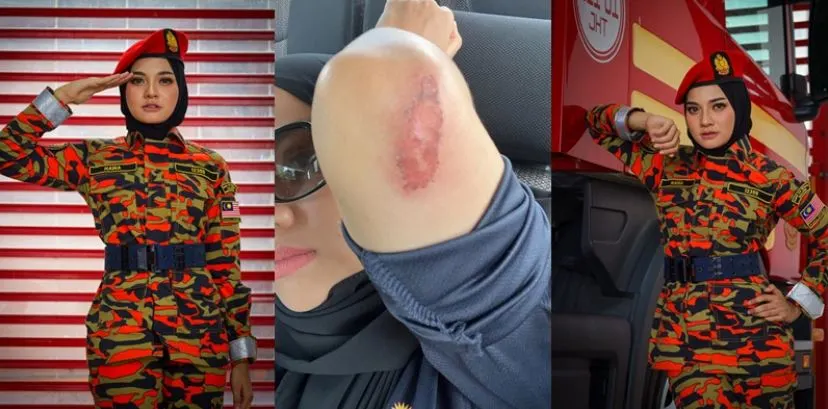 Cantik Dalam Parut: Hawa Rizwana, Wanita Penuh Semangat di Balik Calar-Balar