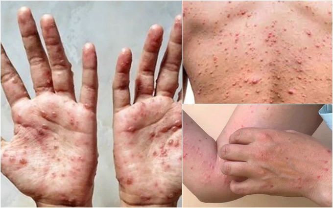 Be alert of monkeypox symptoms, says Perak exco