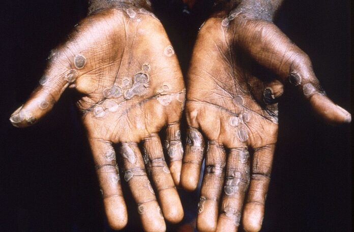 Health Ministry records two cases of monkeypox