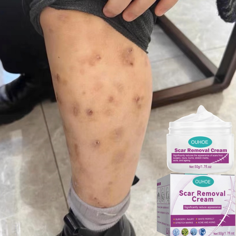 krim hilangkan parut hitam Menghilangkan bekas luka lama Ubat parut kaki Mosquito bite scar Keloid scar Burns Scald scar